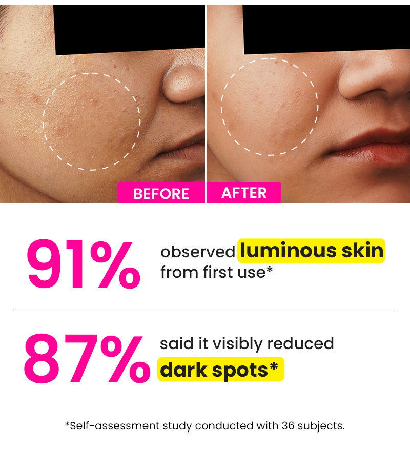 Oily Skin, Kojic acid, Dark spots