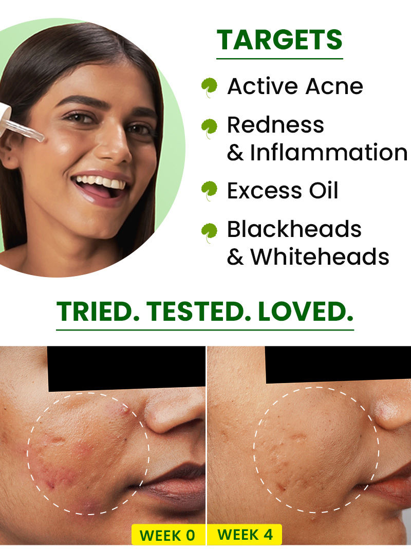paraben free face serum, 2% Salicylic acid serum, Gentle Exfoliating serum