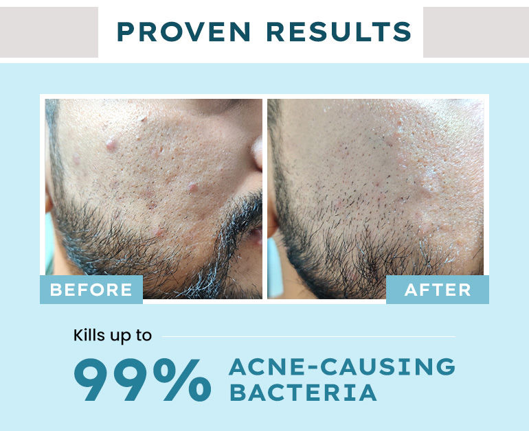 face wash for acne prone skin